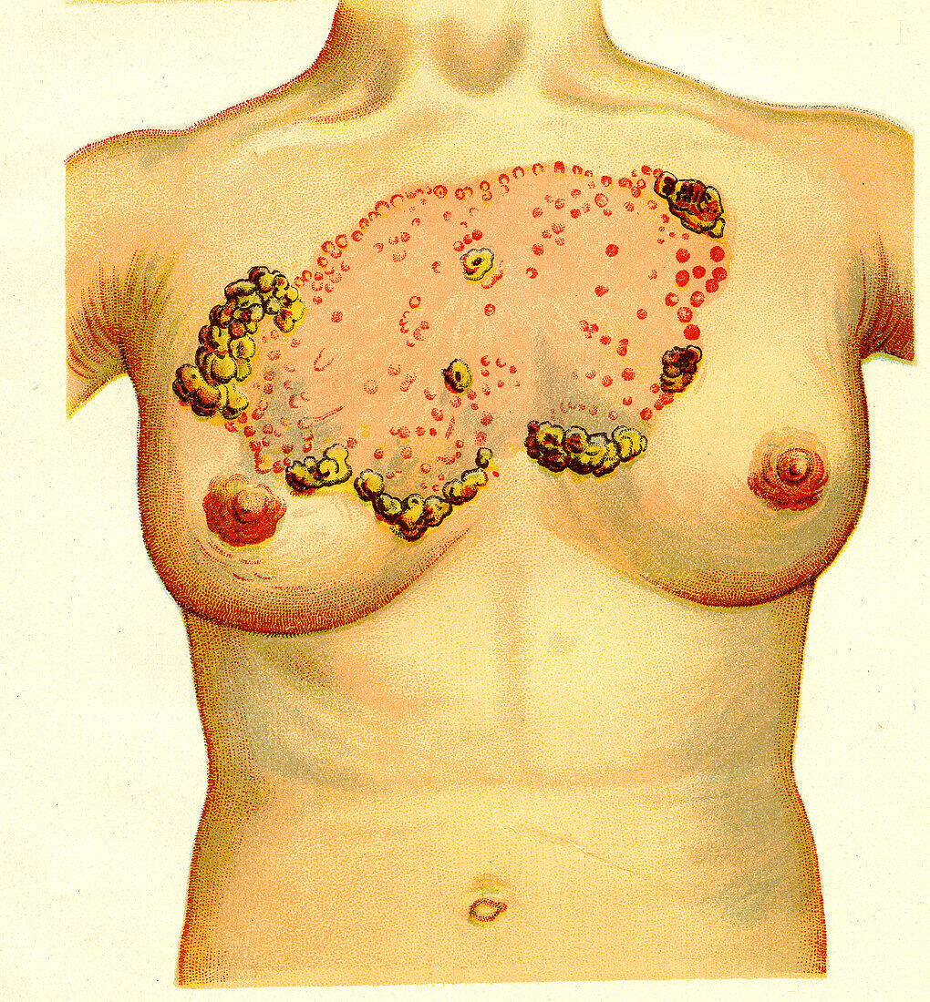 Lupus erythematosus, illustration