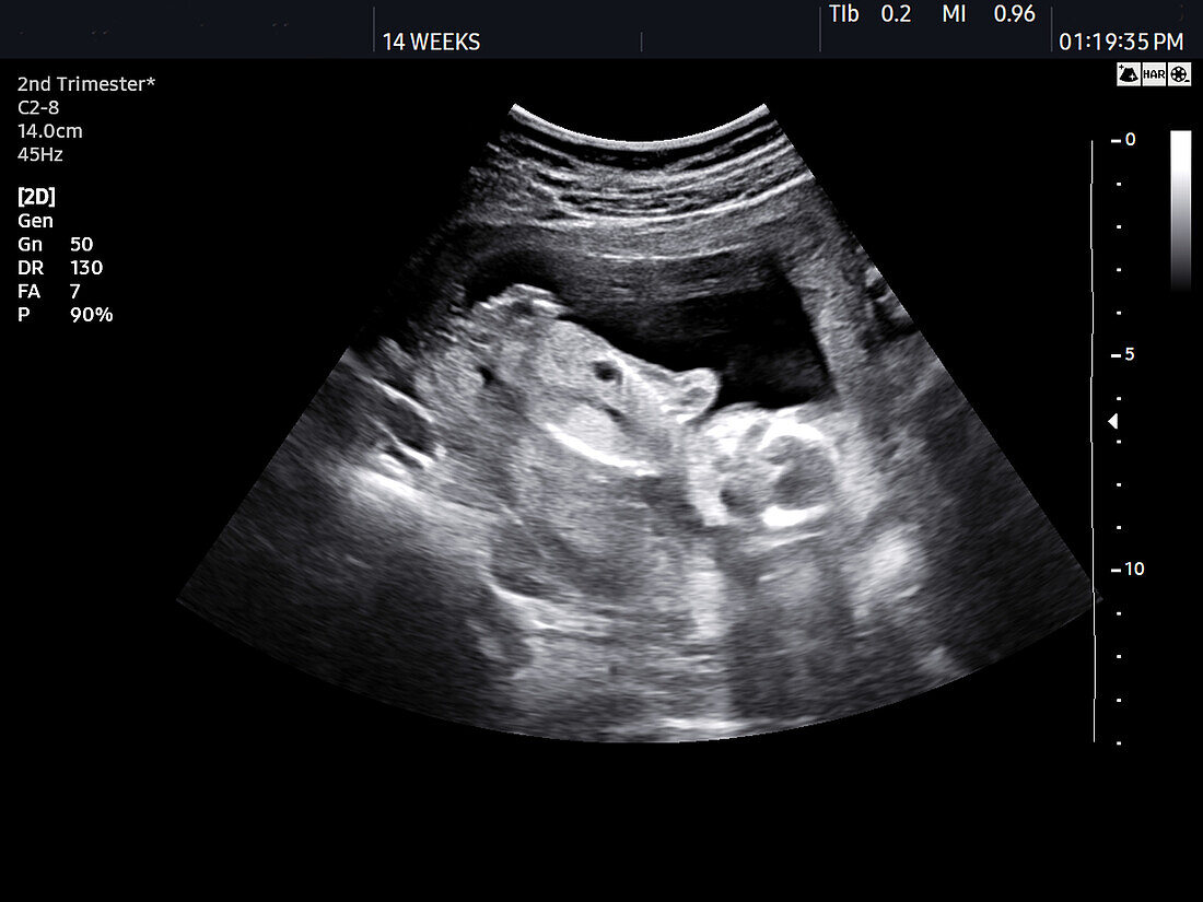 Foetus at 14 weeks, ultrasound scan