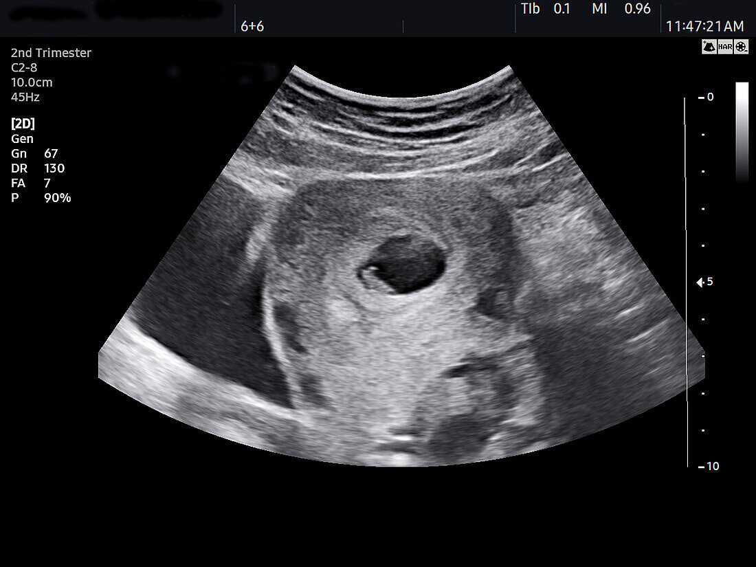 Embryo at 6 weeks, ultrasound scan