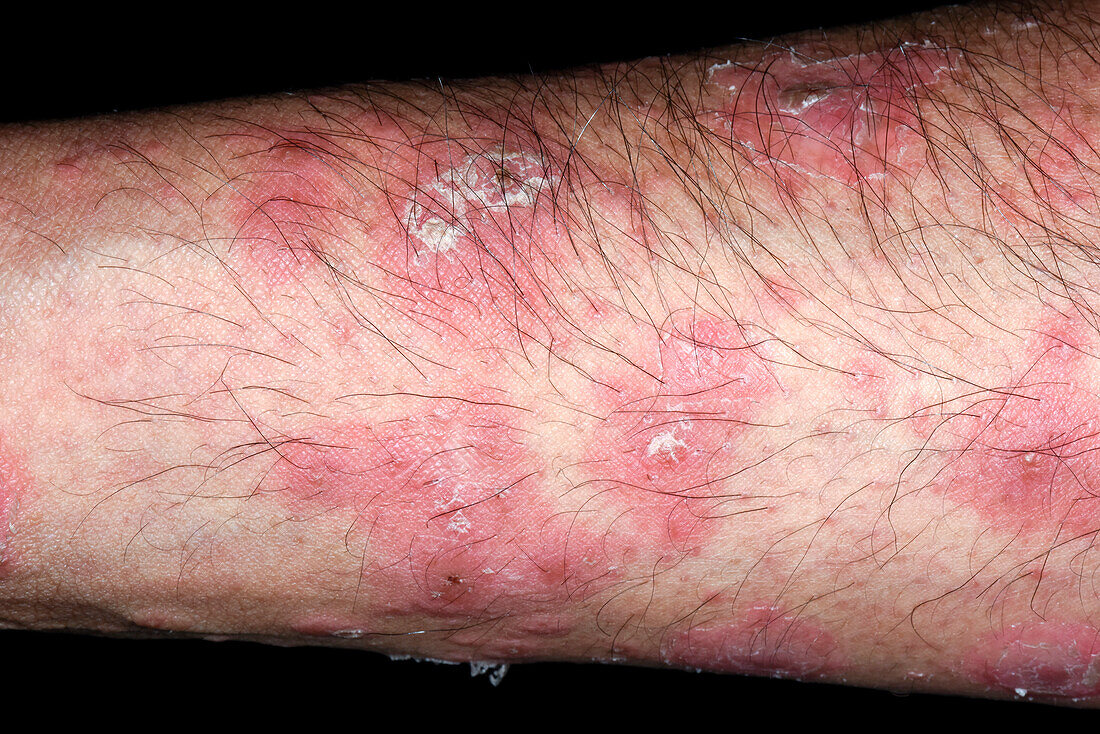 Psoriasis flare-up during treatment