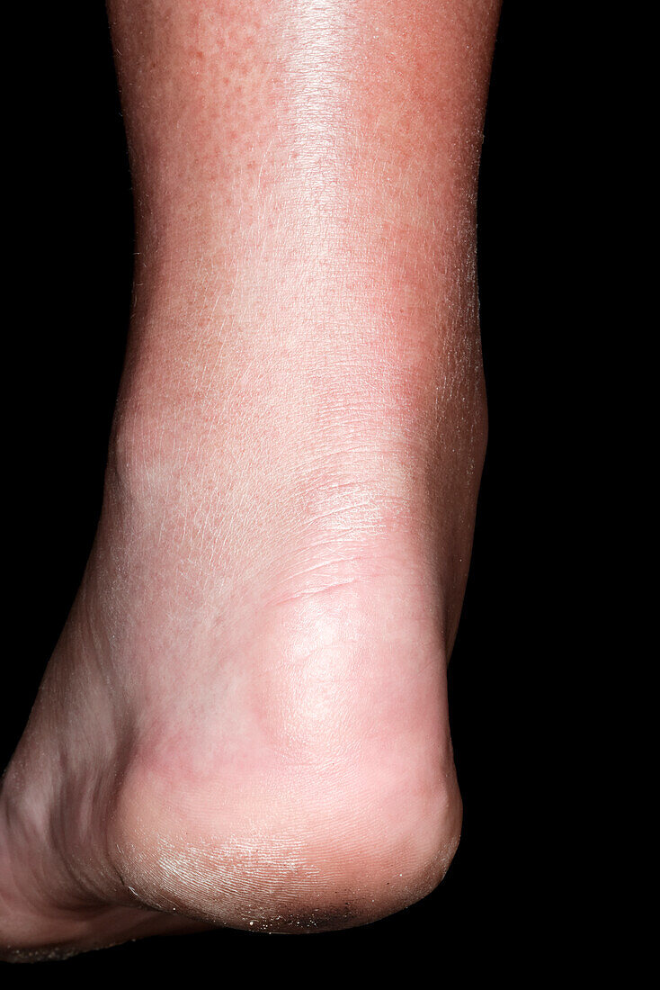 Ruptured Achilles tendon