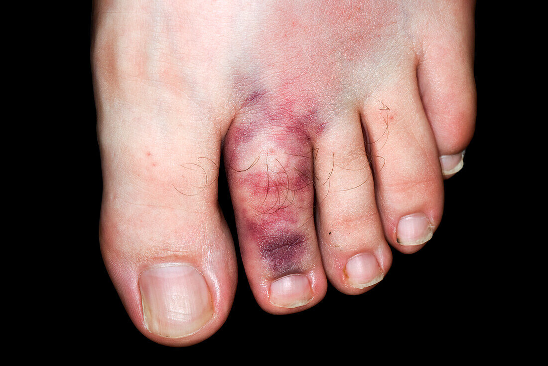 Fractured toe