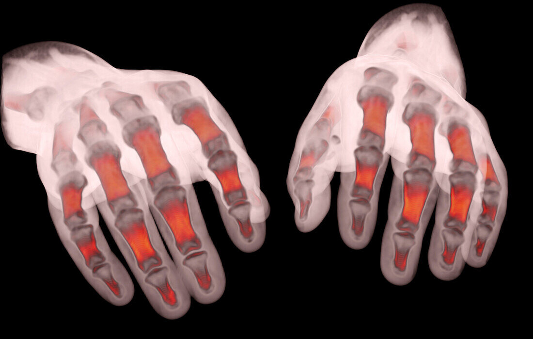 Hands, CT scan