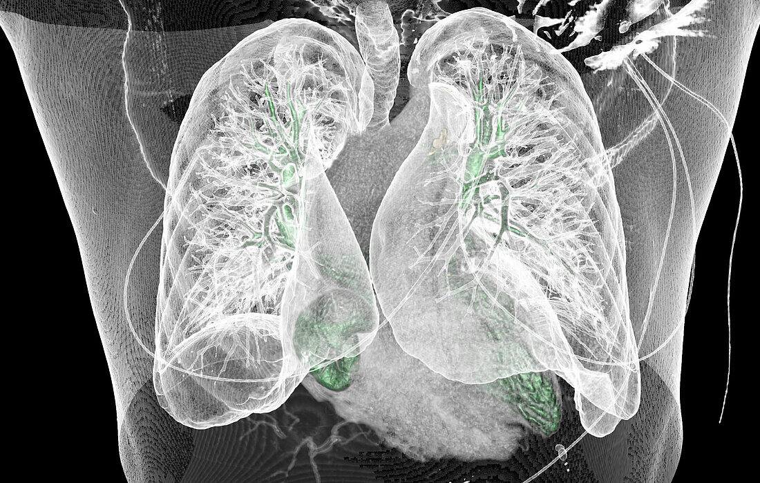Healthy lungs, CT scan