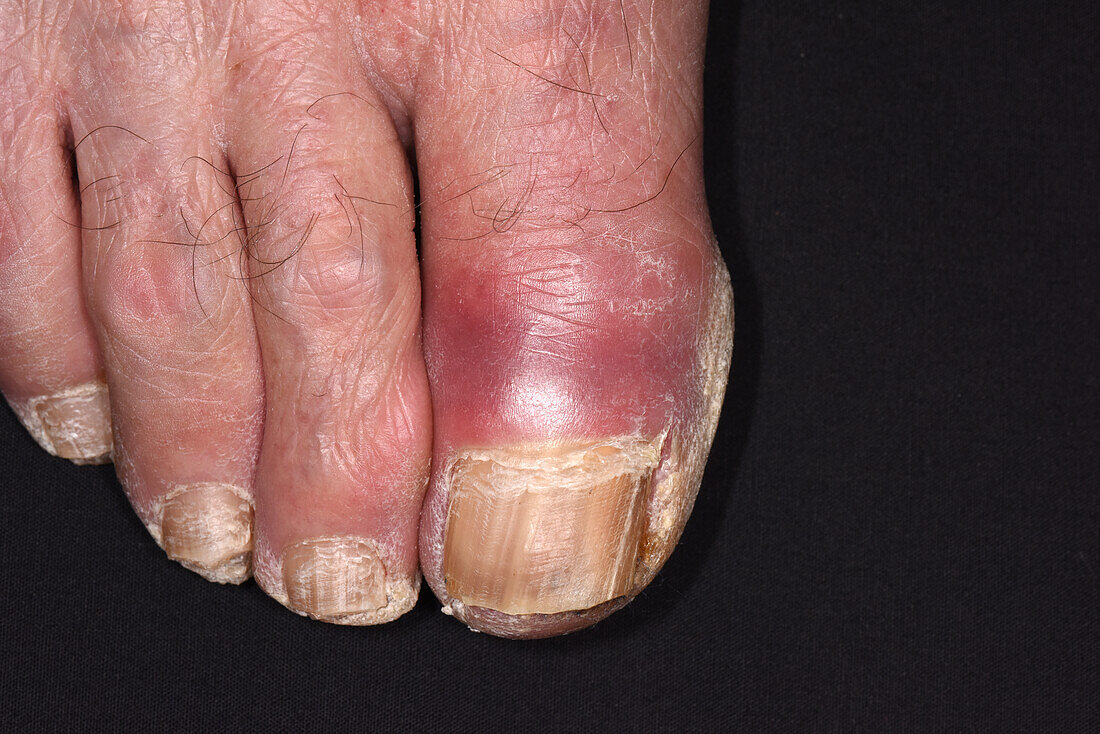 Fungal nail infection on a man's toe