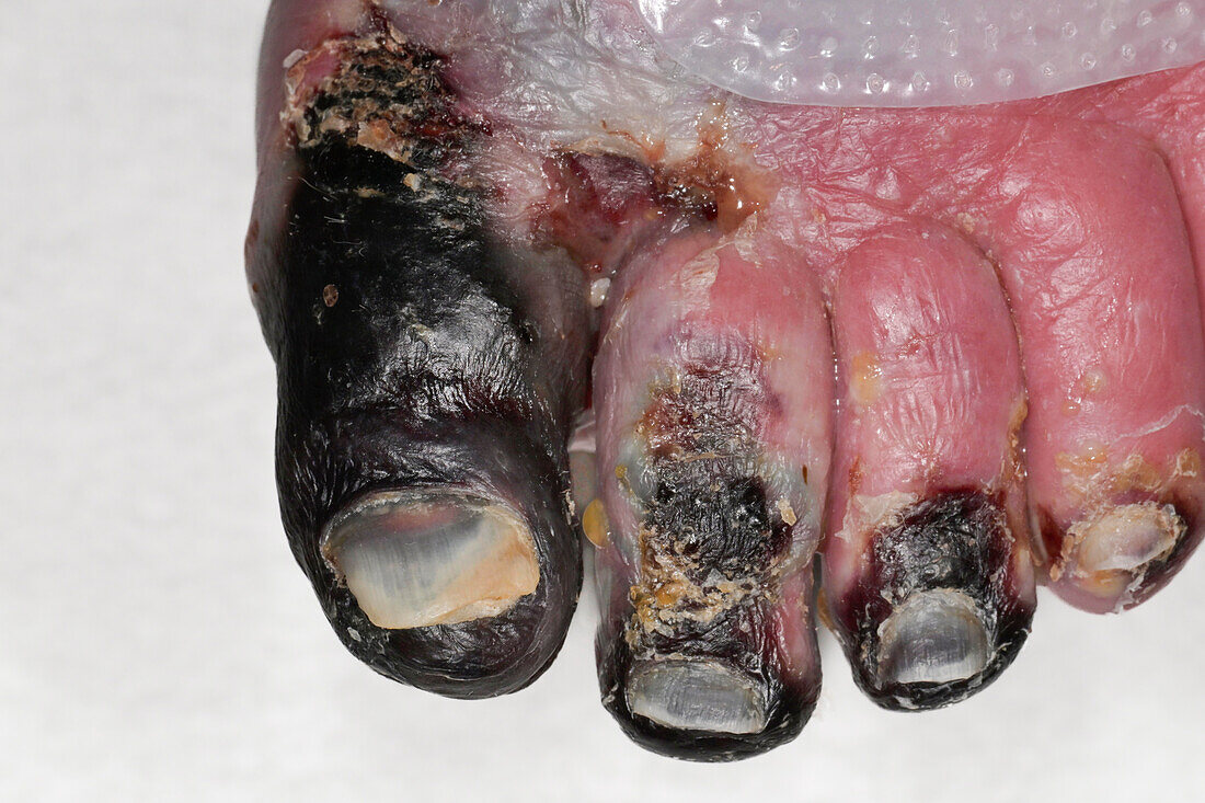 Gangrene from peripheral vascular disease on a woman's toes