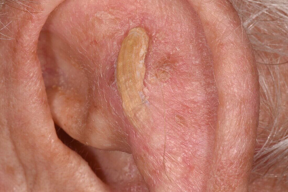 Cutaneous horn on a man's ear
