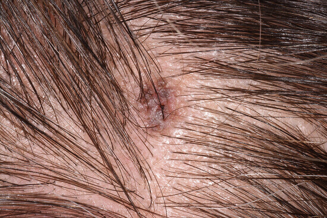 Seborrheic keratosis on a woman's scalp