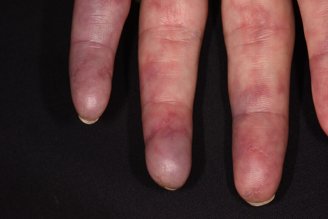 Ischemia on a woman's fingers