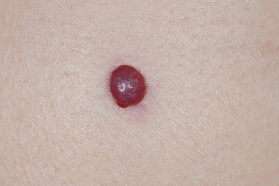 Pyogenic granuloma on girl's skin