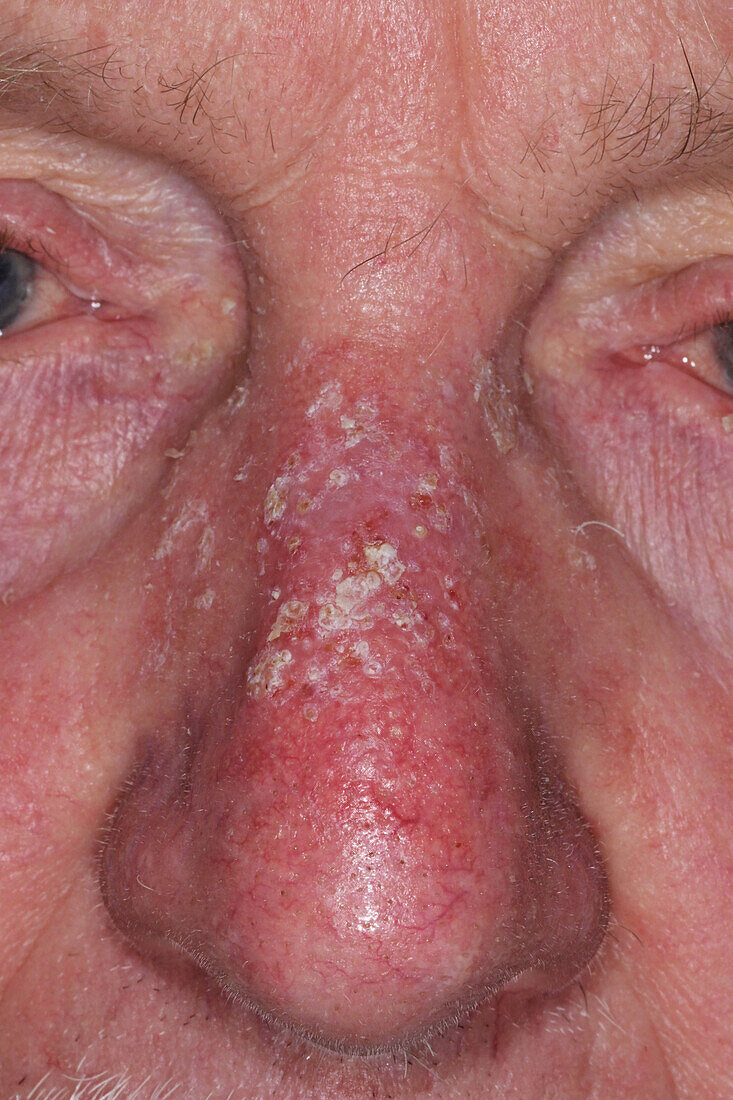 Solar keratosis on a man's nose