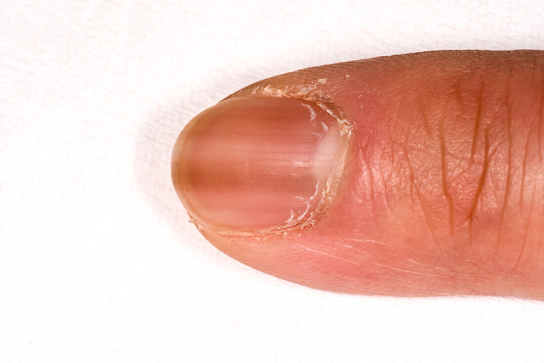 Discoloured nails on a female patient