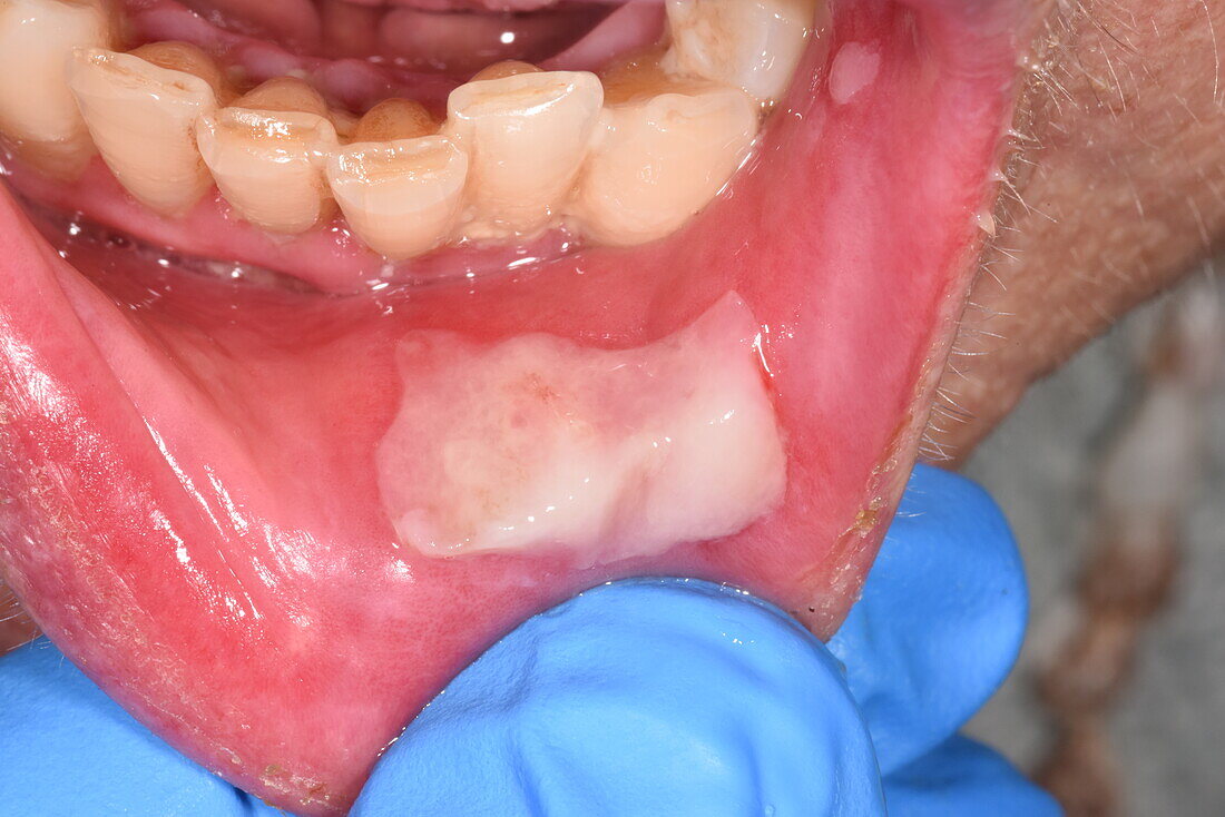 Ulcer in a woman's mouth