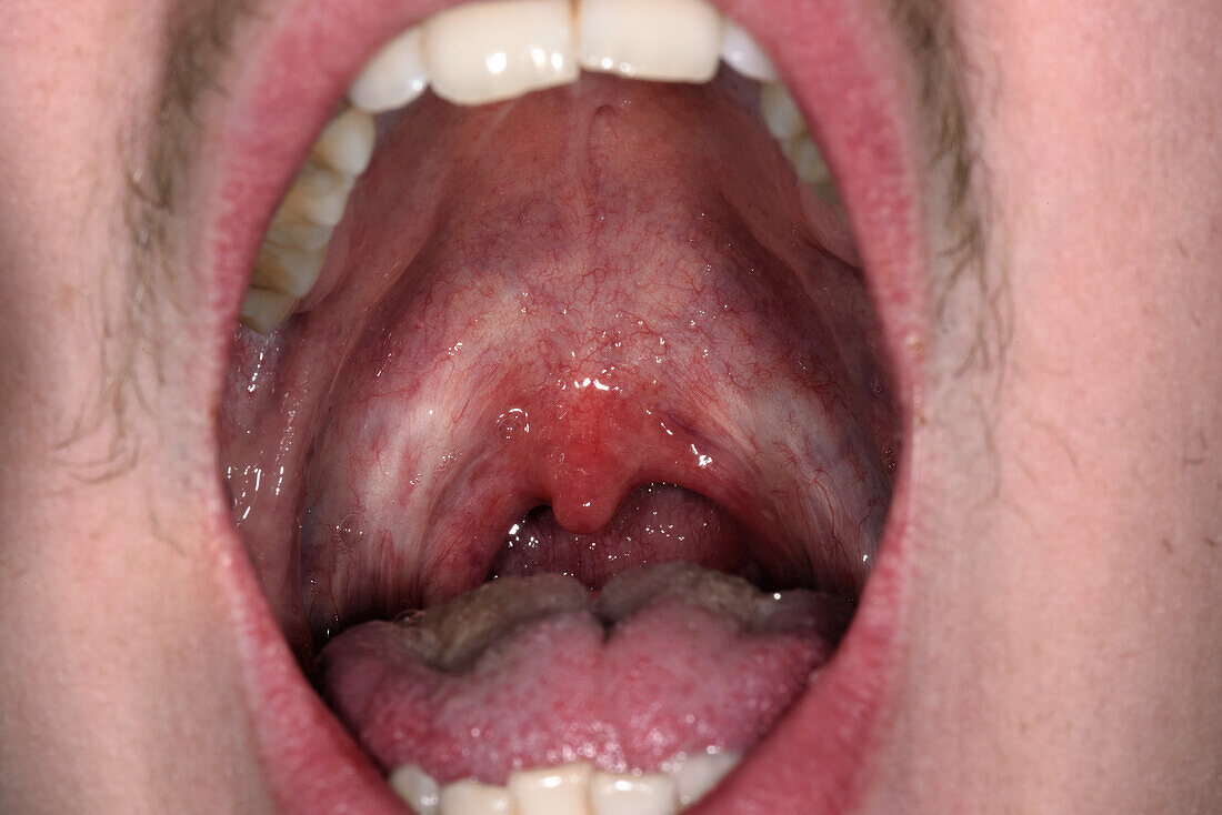 Strep throat infection in a man's throat