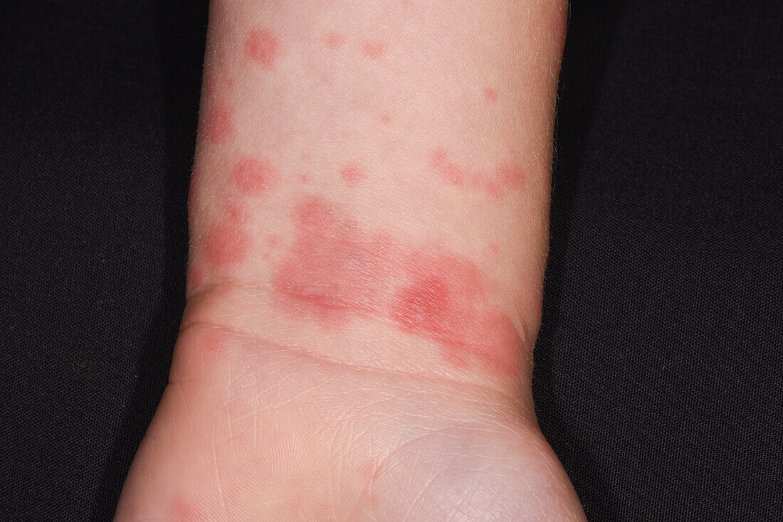 Erythema multiforme on a girl's wrist