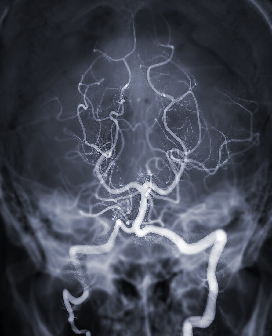 Cerebral arteries, angiogram