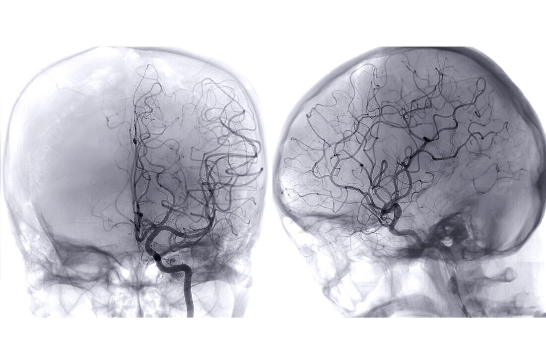 Cerebral arteries, angiograms