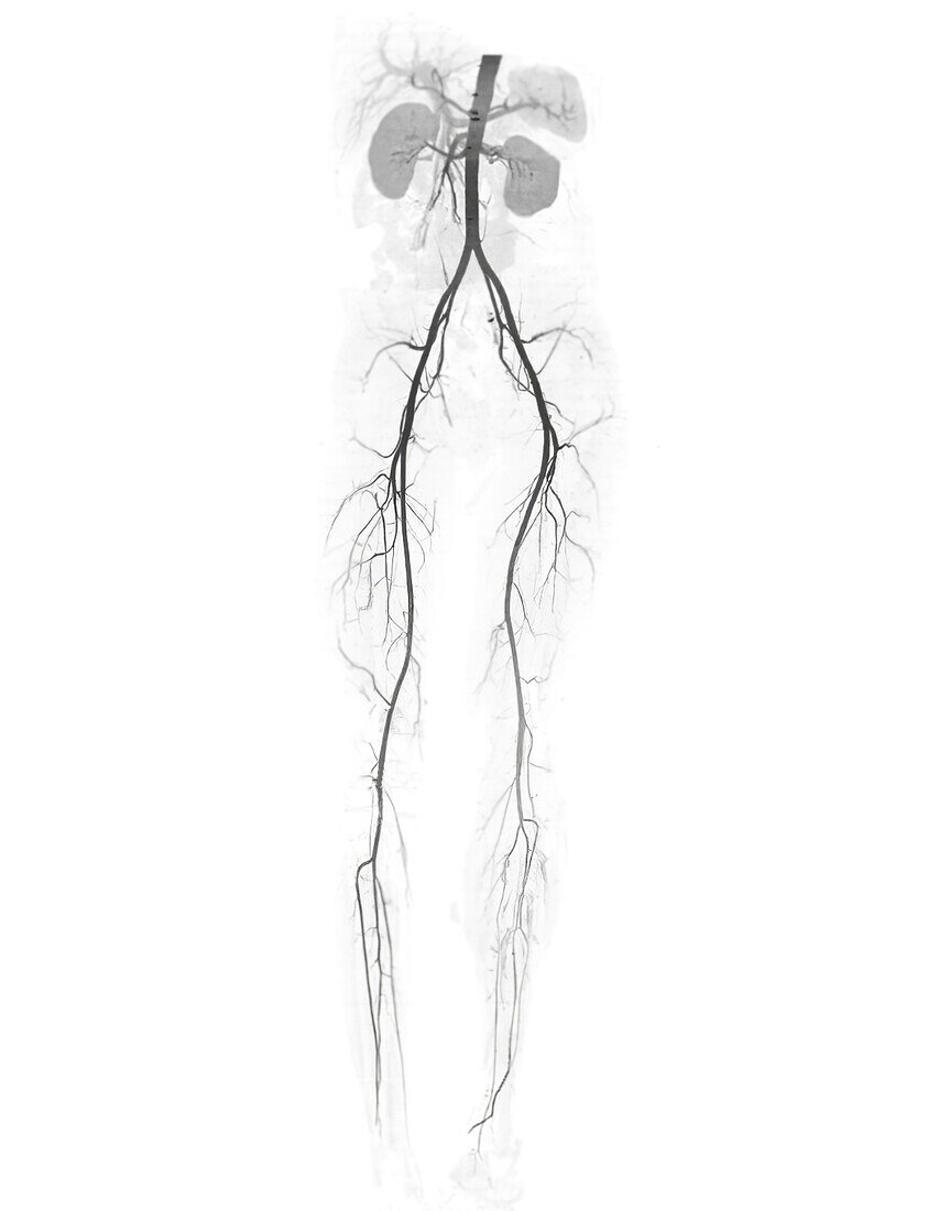 Torso and leg arteries, CT scan