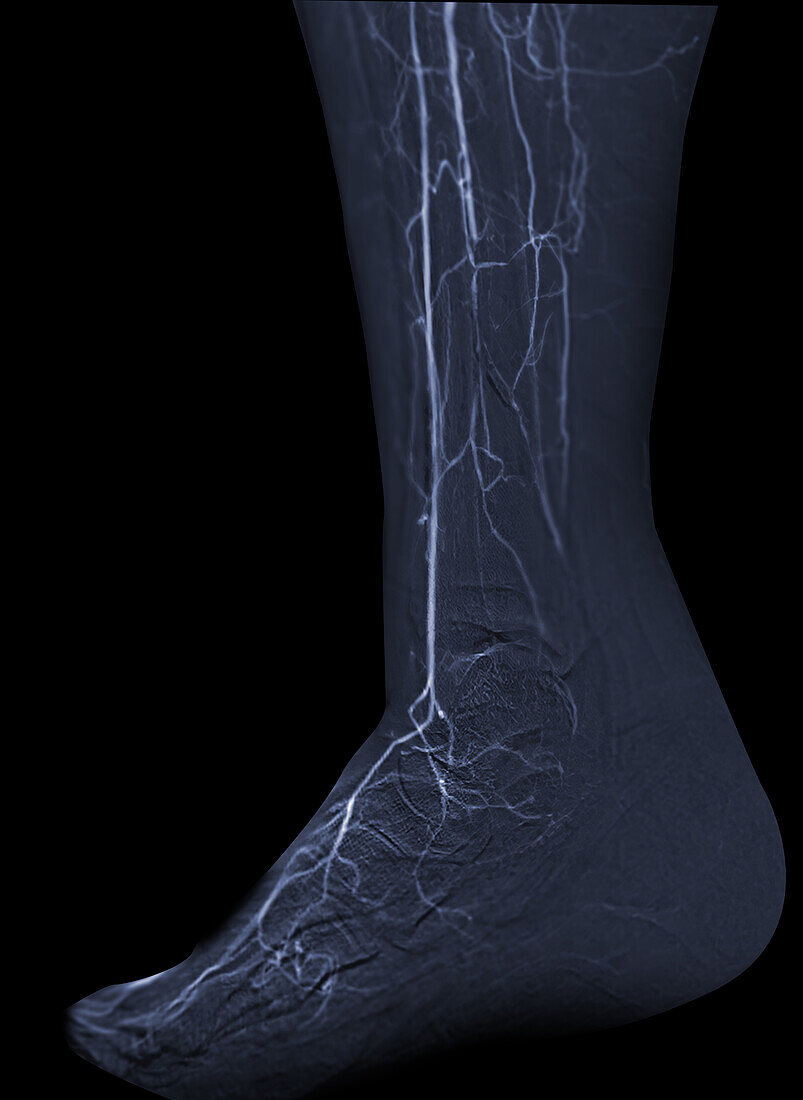 Lower leg and foot arteries, CT scan