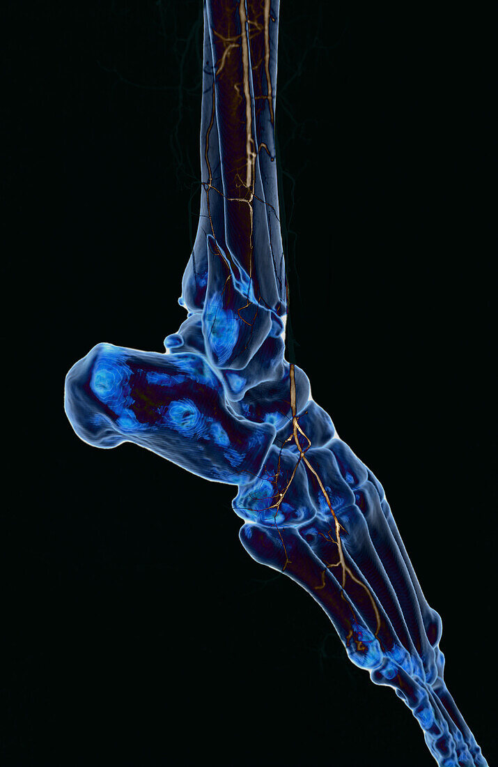 Ankle and foot arteries, CT scan