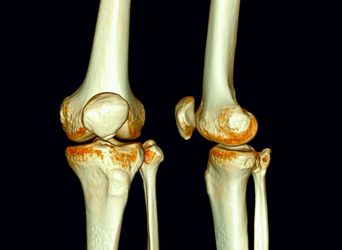 Knee joint, CT scans