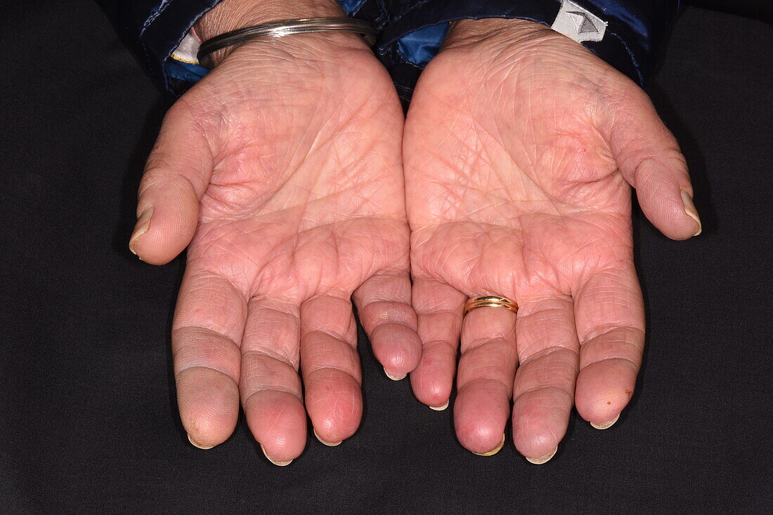Raynaud's phenomenon in a woman's hands