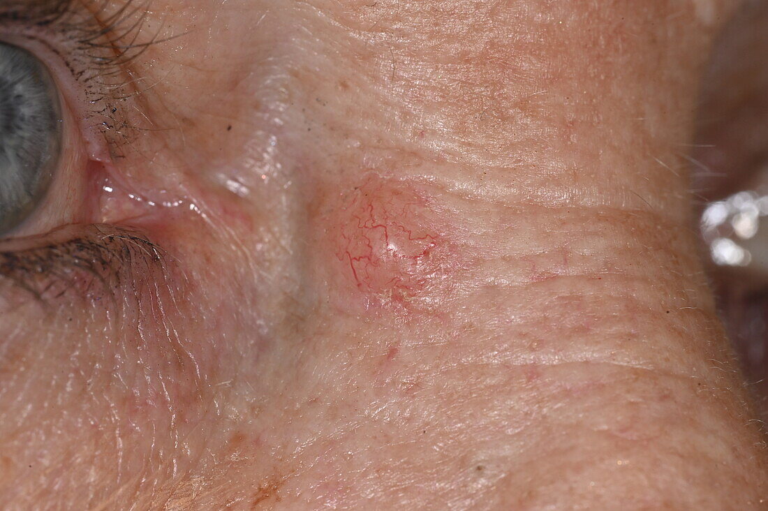 Nodular basal cell carcinoma on a woman's face