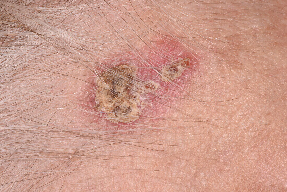 Basal cell carcinoma on a woman's forehead