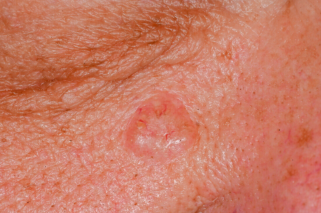 Nodular basal cell carcinoma on a man's cheek