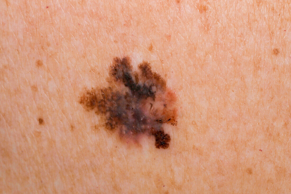 Malignant melanoma on a man's shoulder