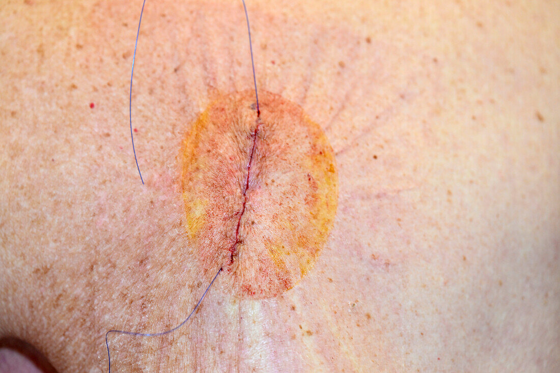 Stitches after malignant melanoma excision