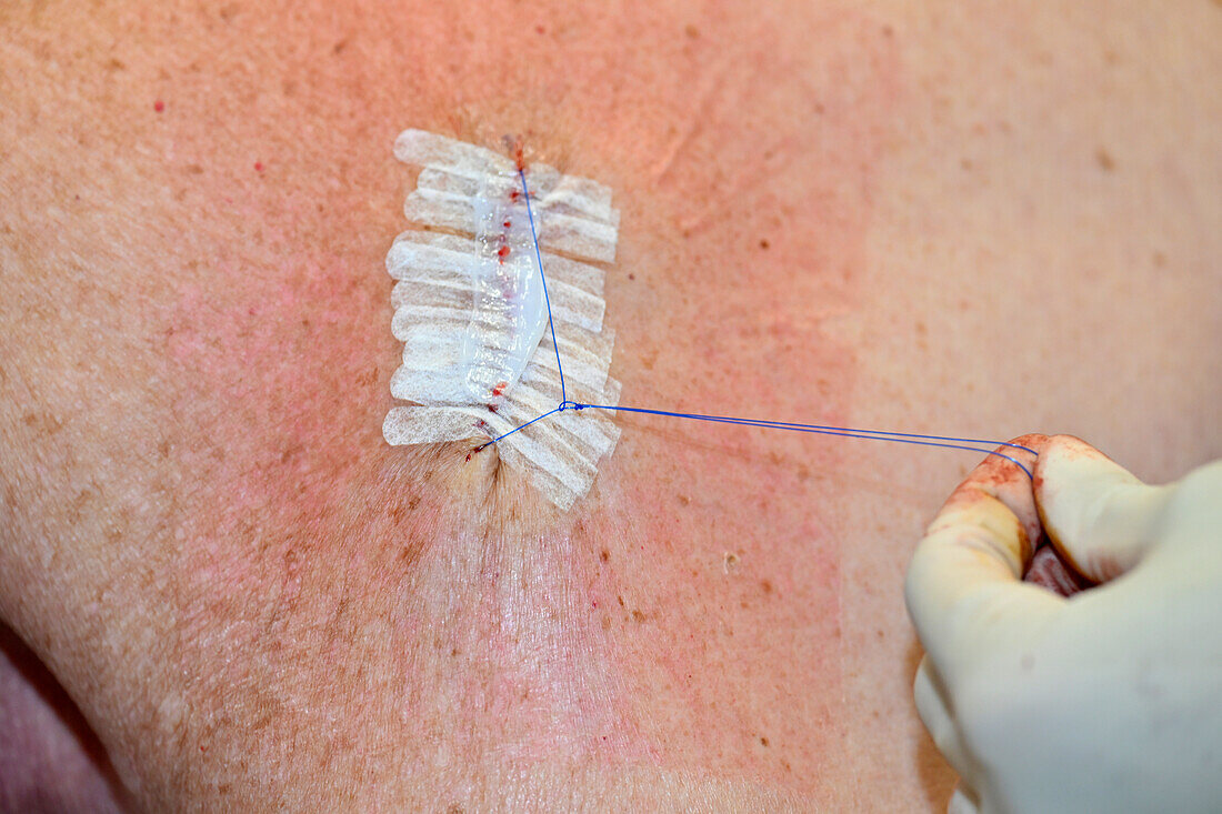 Repairing wound after malignant melanoma excision