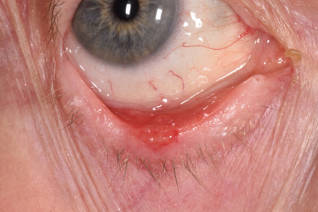 Meibomian cyst in a woman's eye