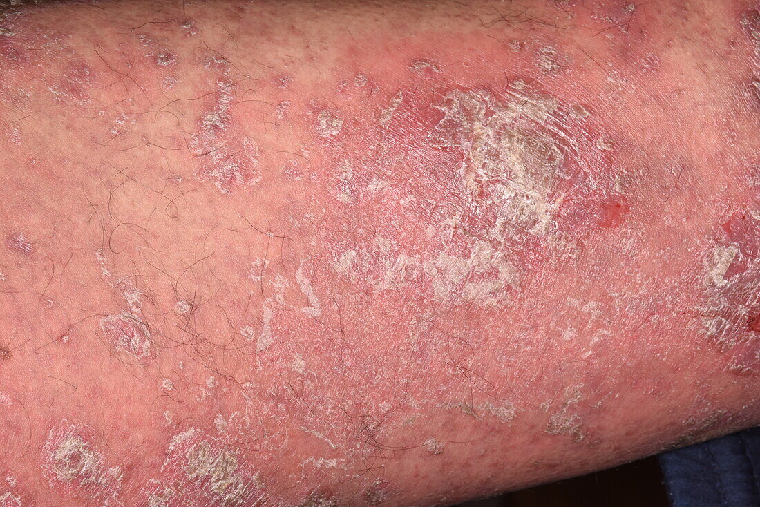 Psoriasis on a man's skin