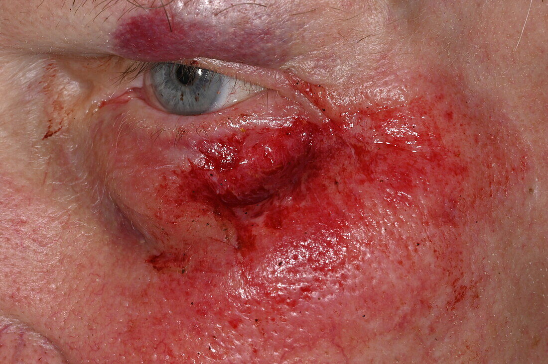 Facial injury on a man's face