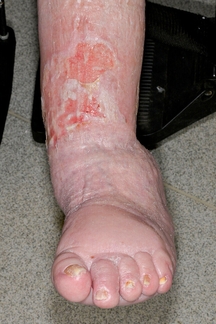 Deformed ankle following fracture