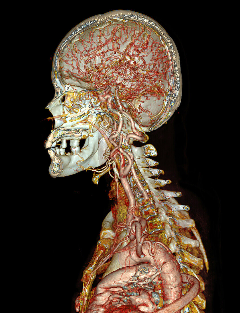 Head and shoulders, CT scan