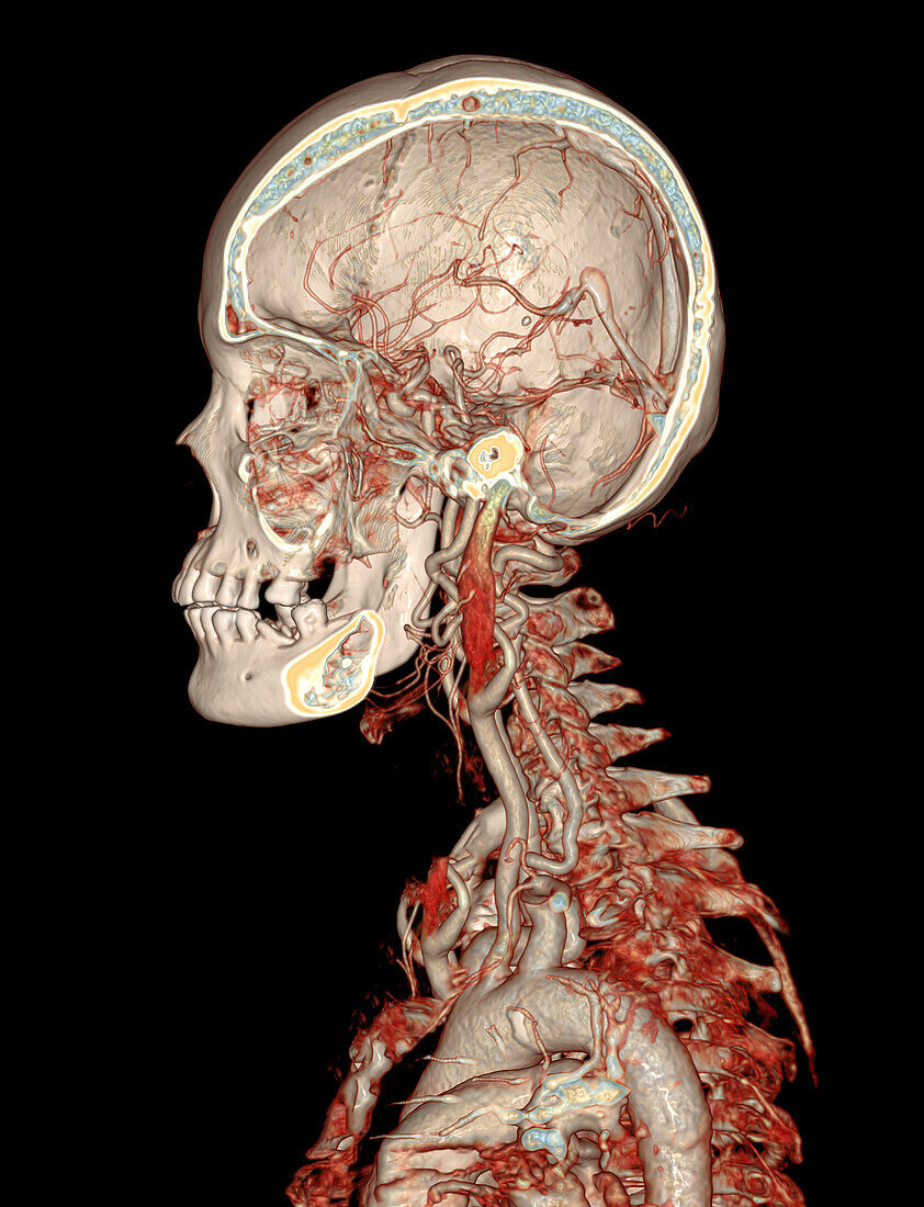 Head and shoulders, CT scan
