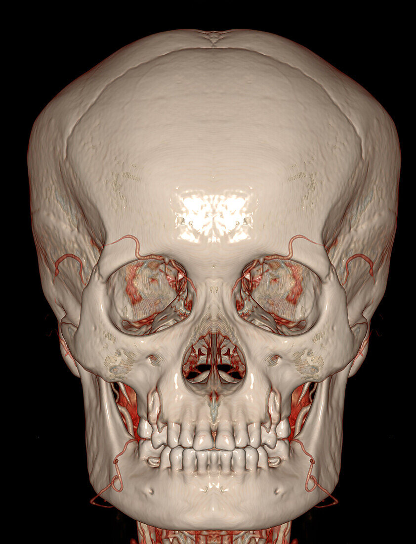 Skull, CT scan