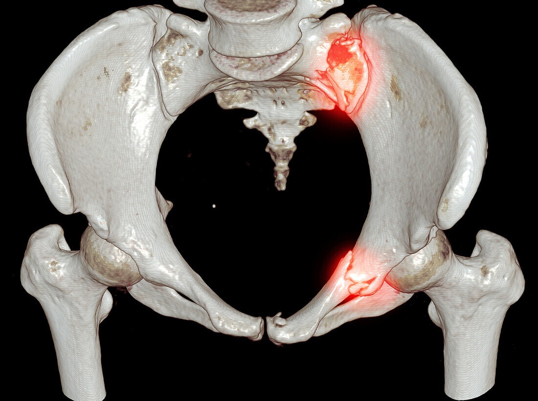 Fractured pelvis, CT scan
