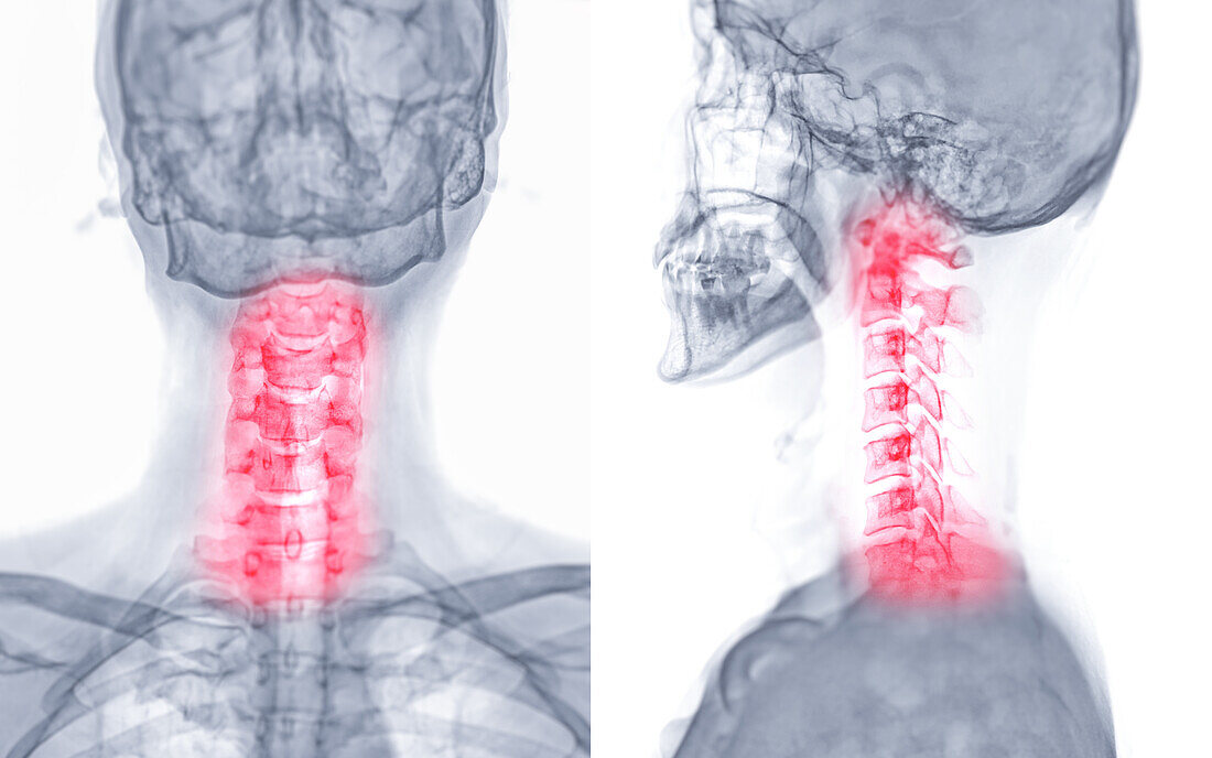 Neck pain, conceptual X-ray