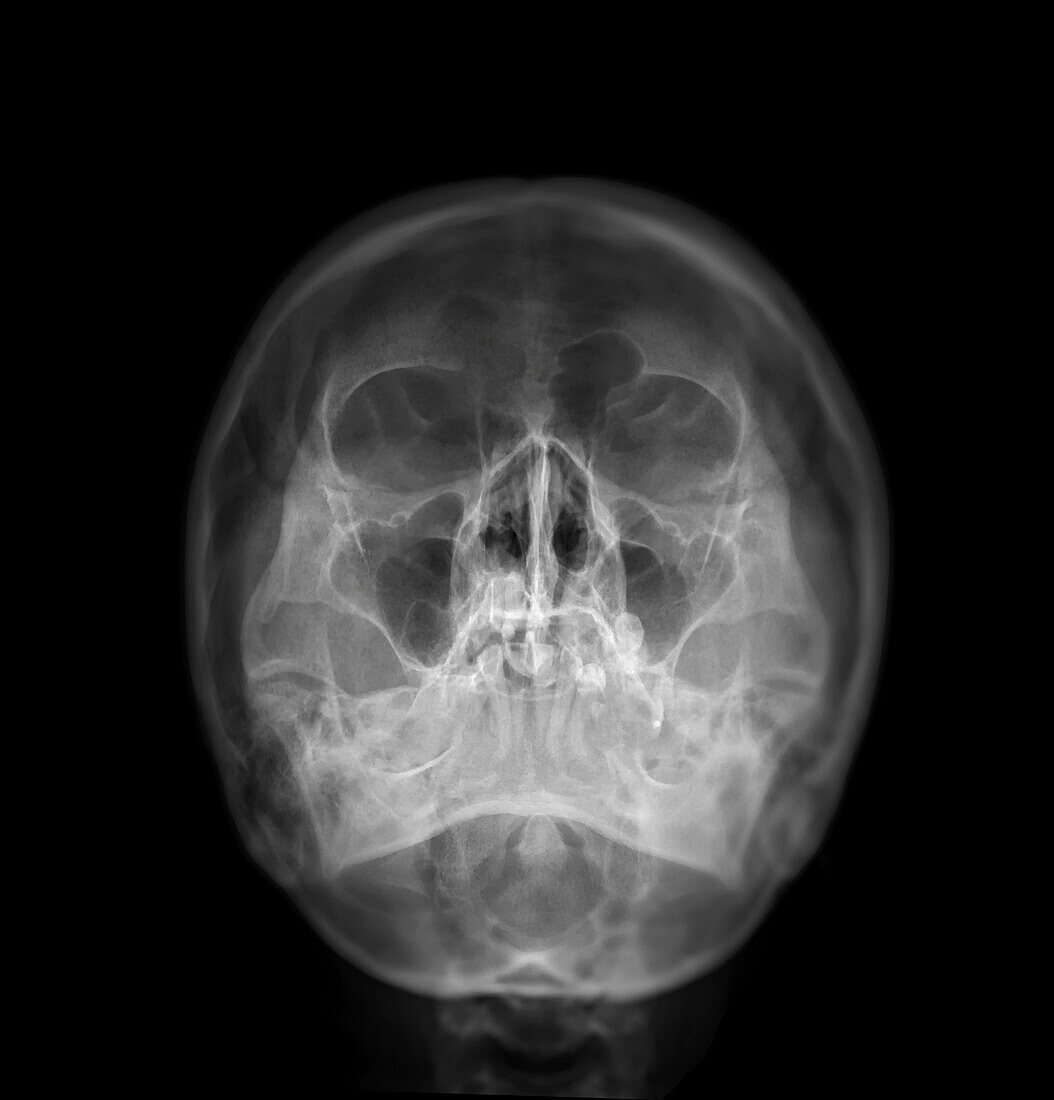 Sinuses, X-ray