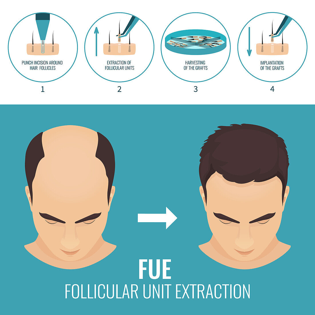 FUE hair transplantation, illustration