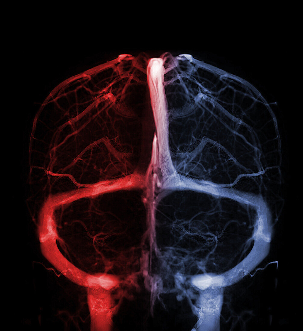 Cerebral veins, MRV scan