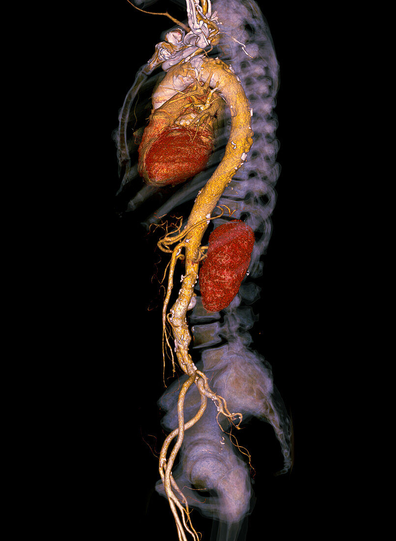 Human torso, CT scan