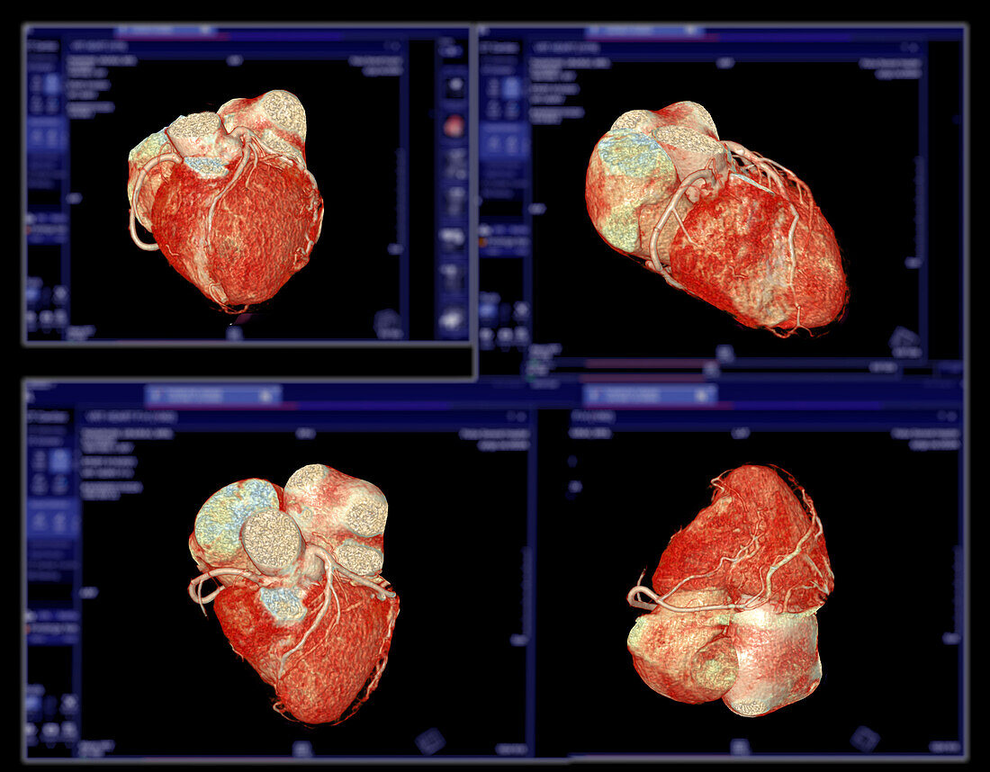 Healthy coronary arteries, CT scans