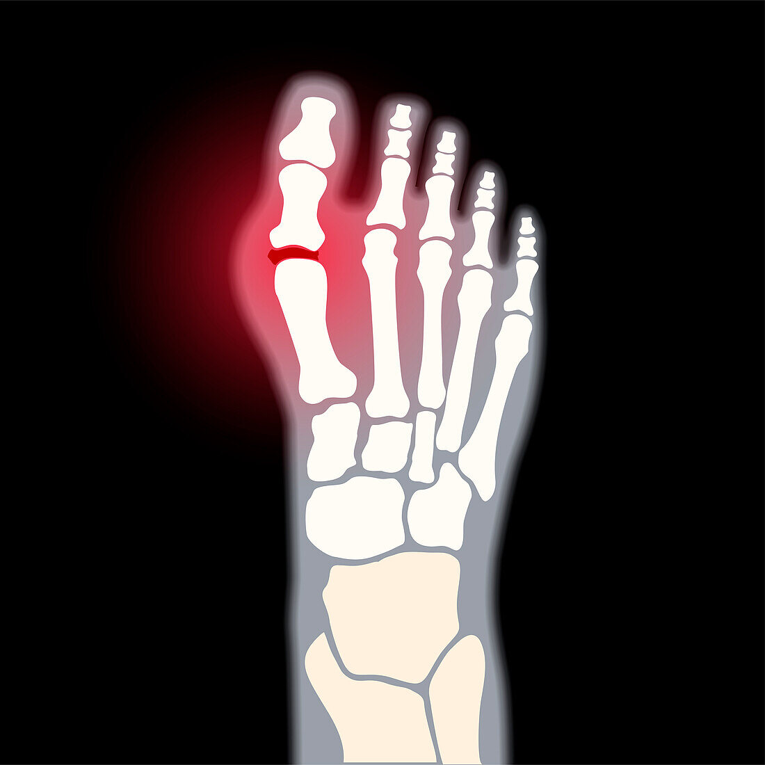 Arthritis of the foot, conceptual illustration
