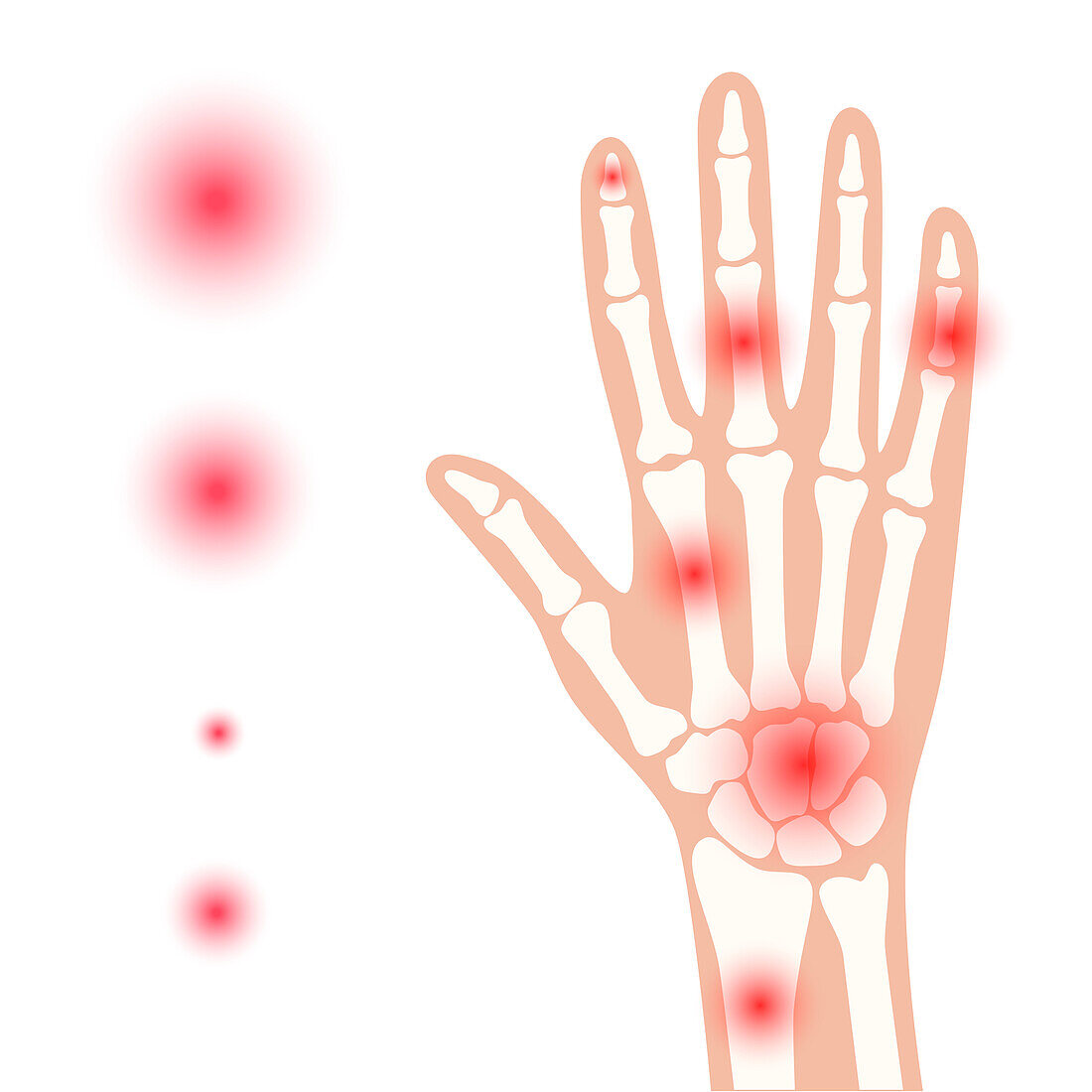 Hand pain, conceptual illustration