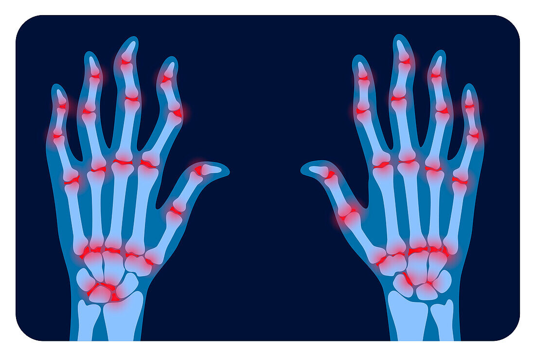 Arthritic hands, conceptual illustration