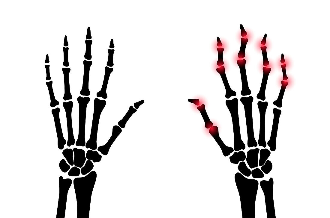 Healthy and arthritic hands, conceptual illustration